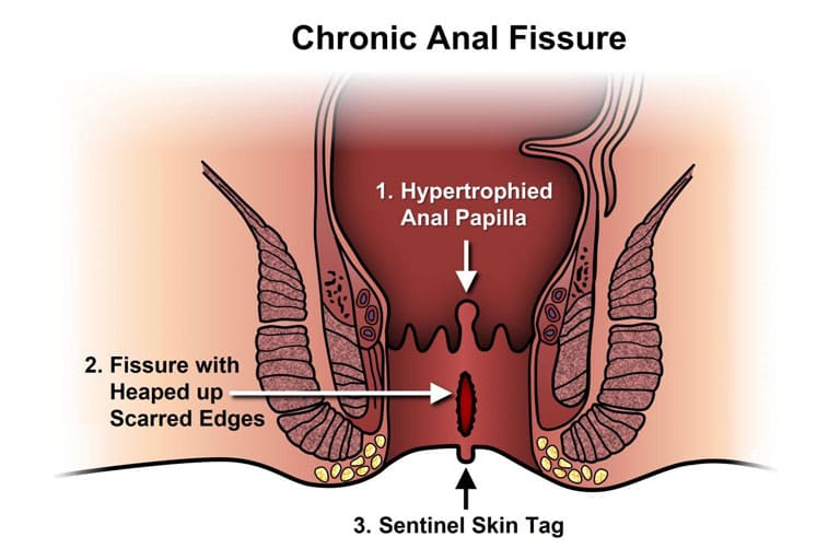 Anal Fissures